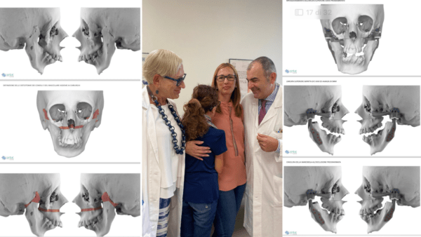 All’ospedale San Marco l’intervento chirurgico permette ad Aurora di aprire la bocca dopo 16 anni